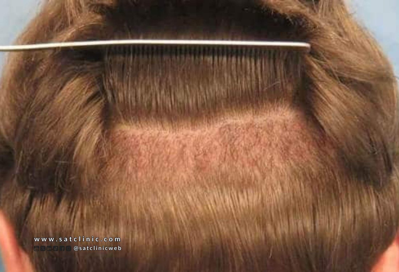 متى تثبت البصيلات بعد زراعة الشعر؟ نصائح ذهبية للأطباء