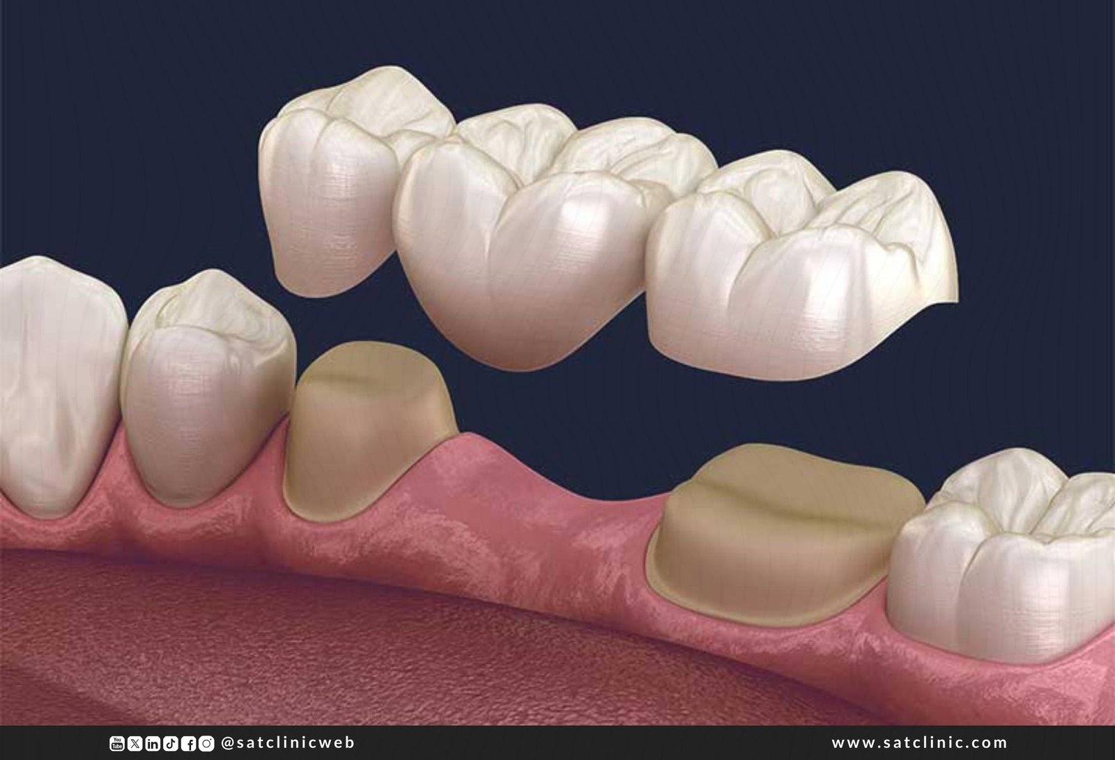 جسور الأسنان - استعد ابتسامتك بأحدث تقنيات الجسور الثابتة