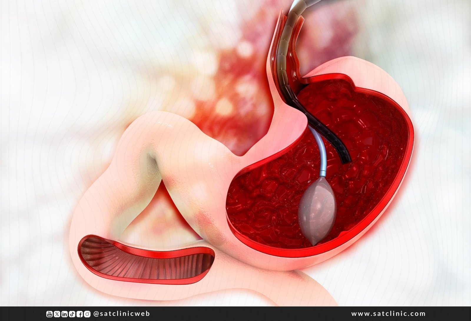 عملية بالون المعدة في تركيا - المميزات، التكلفة، الأنواع
